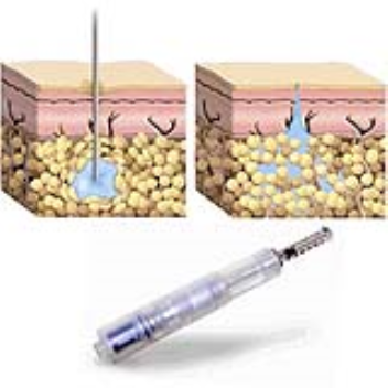 Needle-free injection system with pyrotechnical gas propulsion