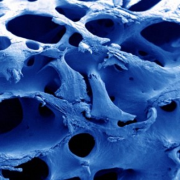 New putty may repair bone fractures in days