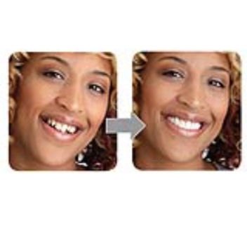 Snap-On Smile is an instant solution for a beautiful smile