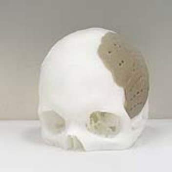 3D-printed implant used to replace 75 percent of man's skull